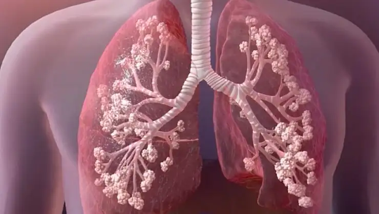 Kistik fibrozis hastalığı nedir?