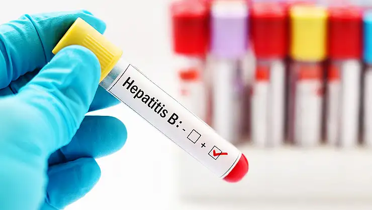 Hepatit B, karaciğer sirozuna yola açabilir