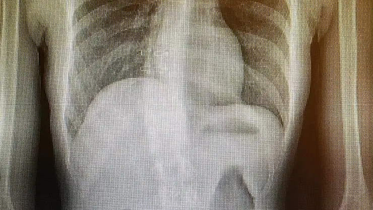 Skolyozda erken tanı çocukları ameliyattan kurtarıyor
