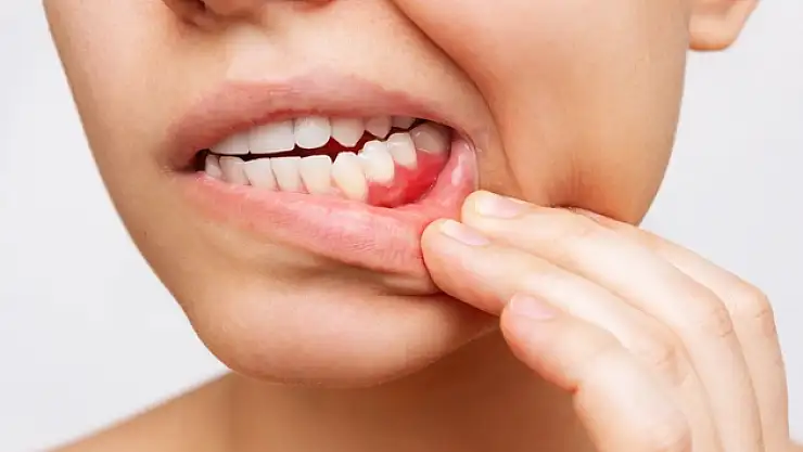 Diş eti hastalıkları, erken doğum ve düşüğe neden olabiliyor