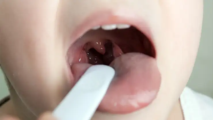 Öpücük hastalığı nedir, belirtileri nelerdir?