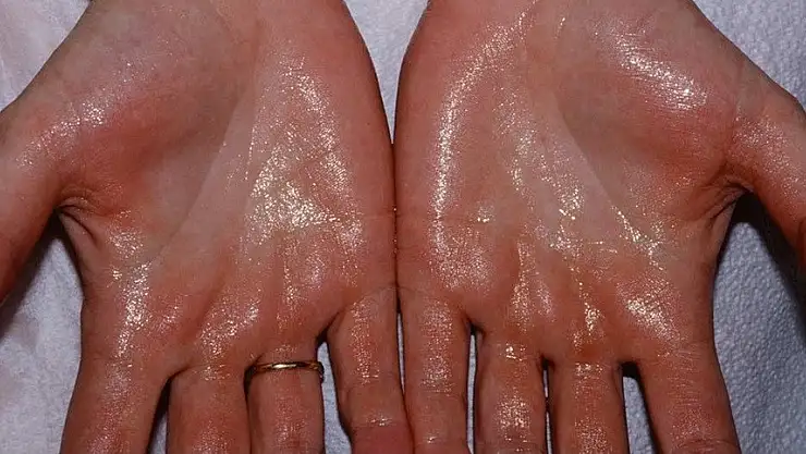 Bitlis'te ilk defa 'El terlemesi' ameliyatı yapıldı