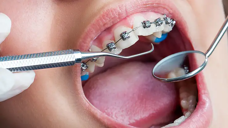 Ortodonti tedavisi için en uygun dönemi uzmanı açıkladı