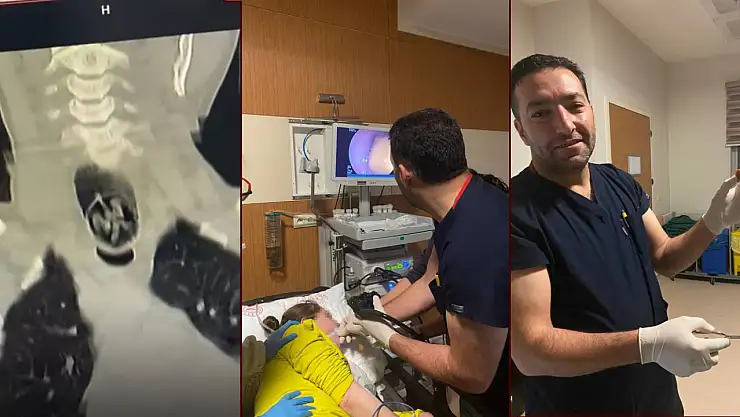 Ağrı'da saniyelerle yarış: Bir kadının yuttuğu ceviz endoskopiyle çıkarıldı