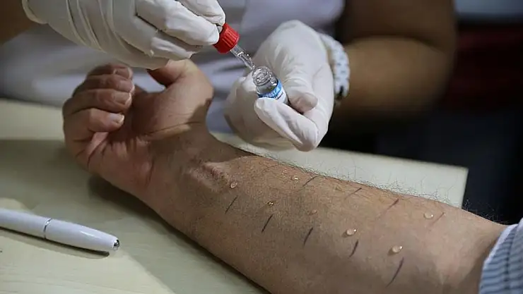 Alerjiler artık nadir değil, toplumun yüzde 20'si risk altında