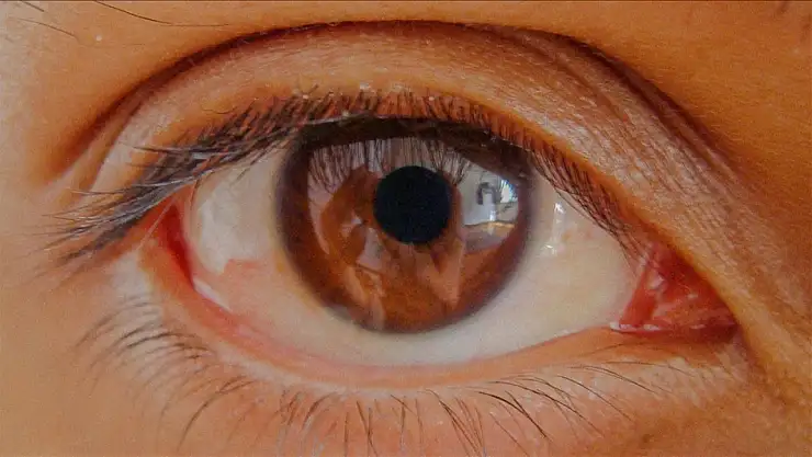 Glokomda erken teşhis kalıcı görme kaybını engelliyor