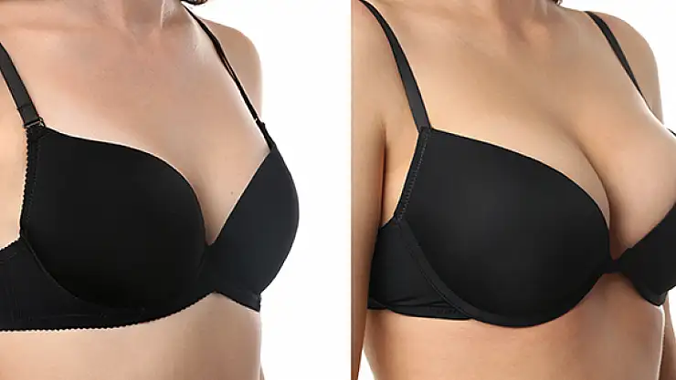 Meme Büyütme ile İdeal Görünüme Yolculuk: Dr. Mehmet Uzuner Rehberliğinde Estetik Bir Başlangıç