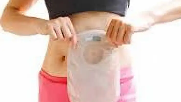 Ostomi  Nedir?