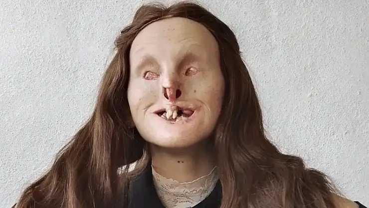 Rabia Yeralmaz Kimdir, Hastalığı Ne, Neden Öyle?