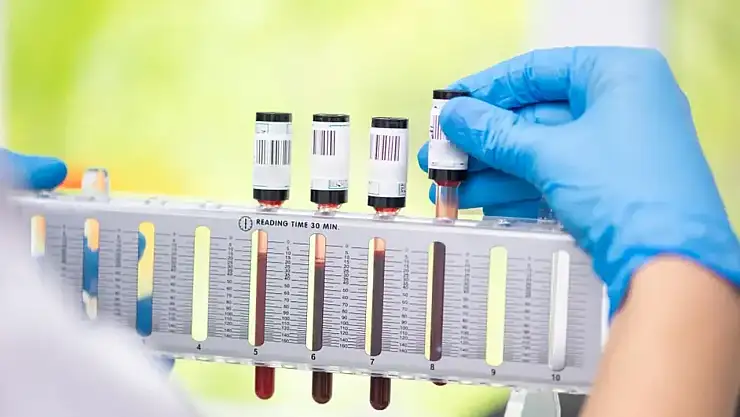 Sedimantasyon Yüksekliği Nedir?