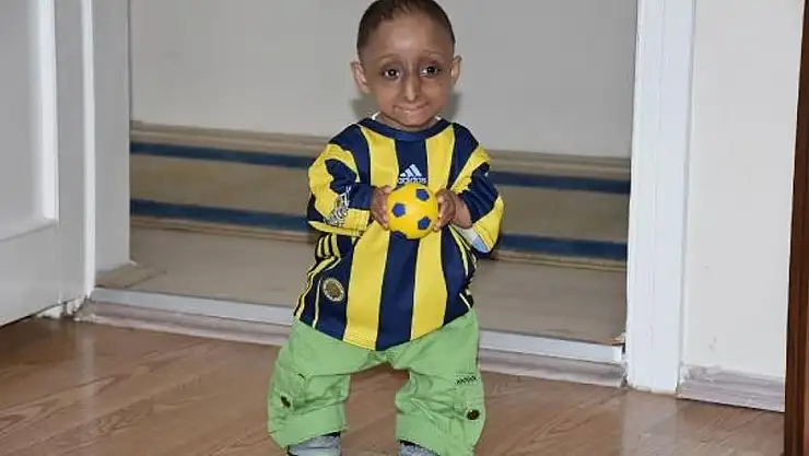 Silver Russell Sendromu Nedir?