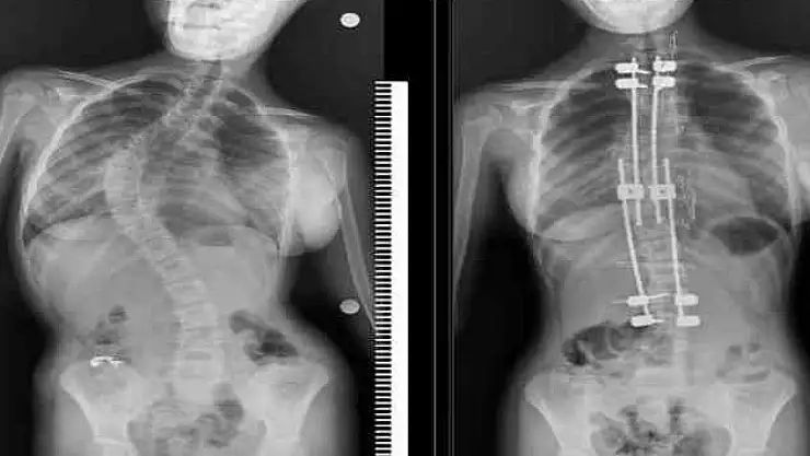 Skolyozlu çocuklar için doğru tedaviyle normal yaşam mümkün