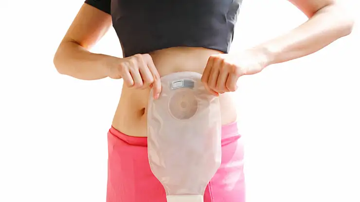 Stoma Torbası Nedir?