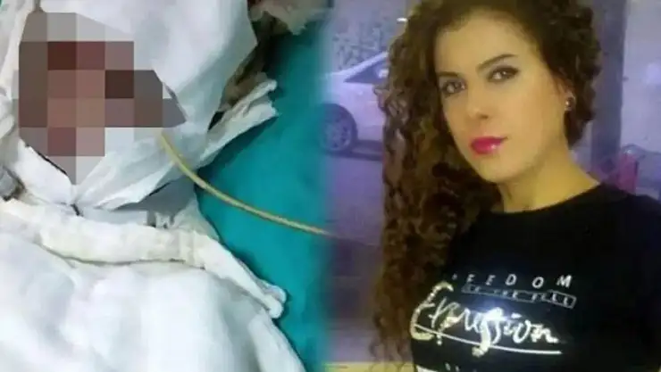 Yasemin Uzunçelebi kimdir, kaç yaşında, olayı nedir, yüzüne ne oldu?