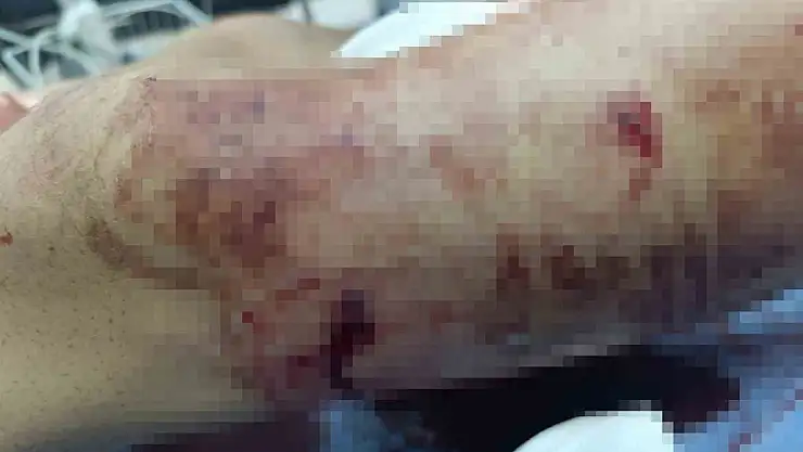 Yaylada inek otlatan gence ayı saldırdı, ciddi yaralandı ve hastaneye kaldırıldı