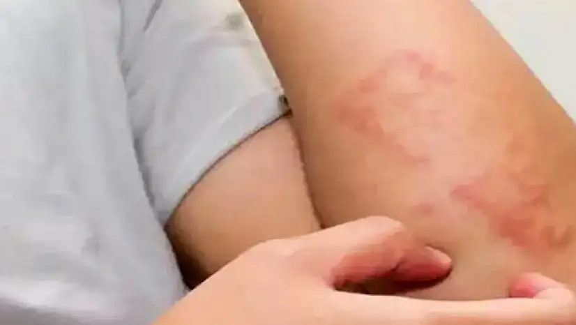 Çocuklarda besin alerjisi uyarısı: Yanlış uygulamalar riski artırıyor