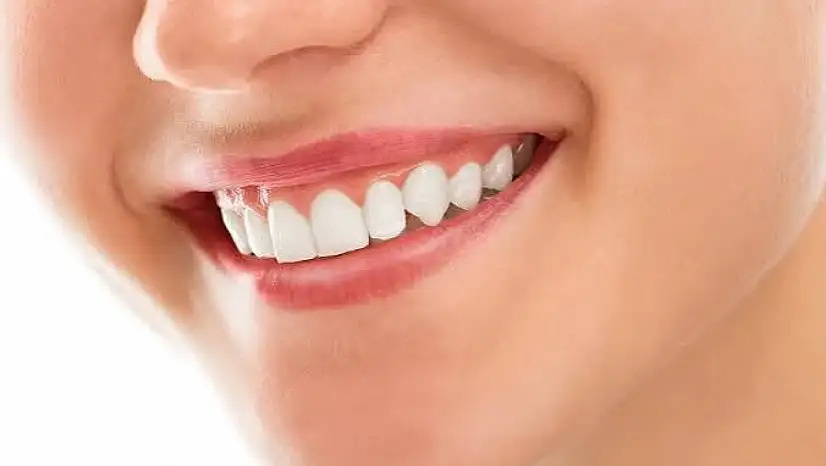 Estetik bir gülüşün sırrı sağlıklı diş etlerinde