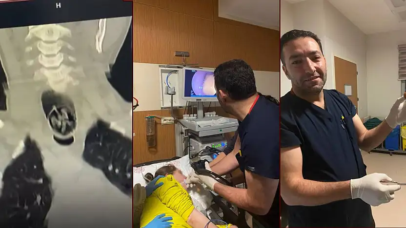 Ağrı'da saniyelerle yarış: Bir kadının yuttuğu ceviz endoskopiyle çıkarıldı